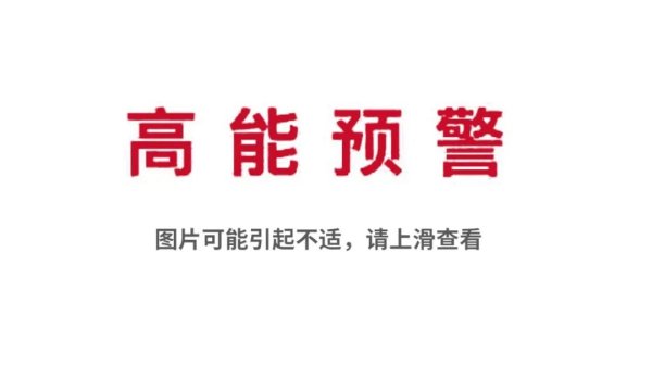 云开体育眼睑、巩膜、结膜、泪囊区、眼压和眼底均正常-开云kaiyun登录入口登录APP下载「中国」官方网站